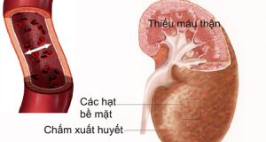 chế độ ăn  bệnh suy thận mã tính giai đoạn III-IV