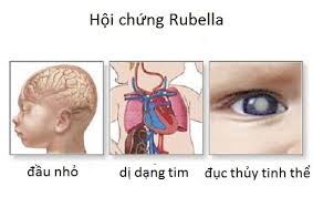 Bệnh RUBELLA và biện pháp phòng chống