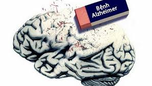 Bệnh Alzheimer